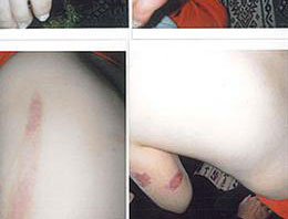 Engelli kıza rehabilitasyonda işkence