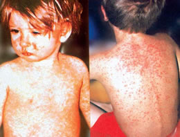 İstanbul'da 24 kızamık vakası!