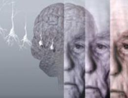 Alzheimer sağlıklı insanlarda da teşhis edilebilecek