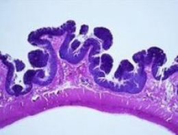 Egzersiz, polip riskini azaltıyor